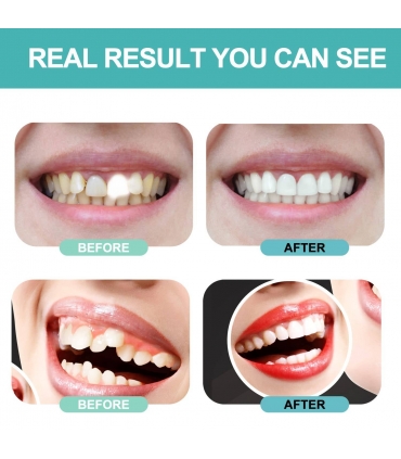 دندان مصنوعی کامپوزیت برای زیبایی JINHUA Fake Teeth