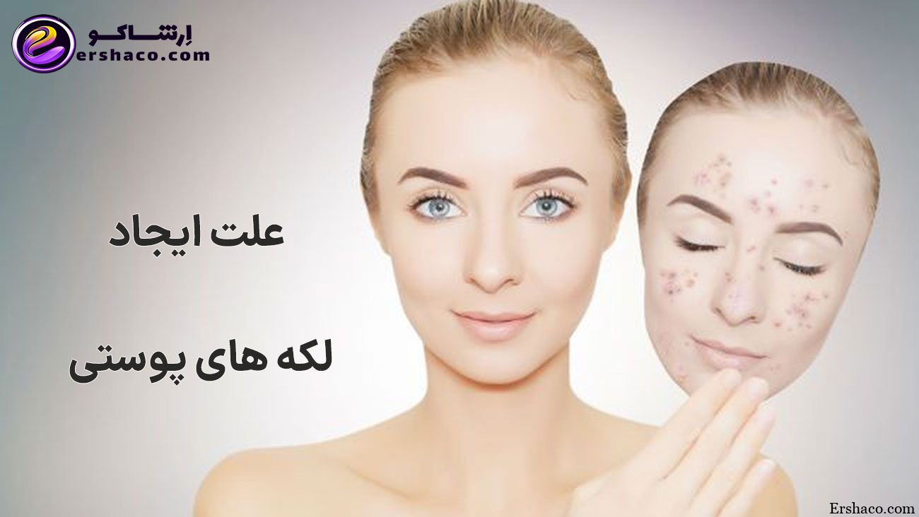 علت ایجاد لکه های پوستی مجله